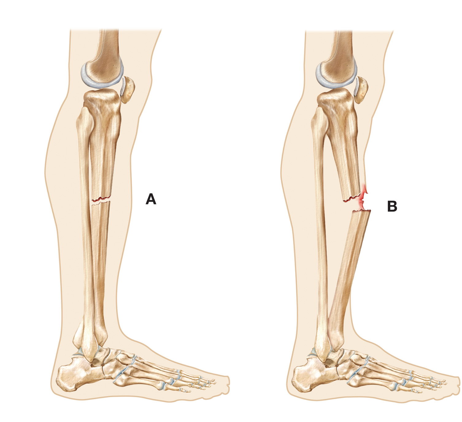 Open Fracture Infection and Treatment